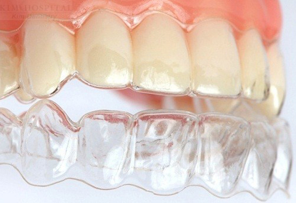 Niềng răng invisalign tại nha khoa Đăng Lưu 1