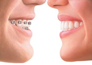 Niềng răng mất bao lâu thì có kết quả như ý? 2