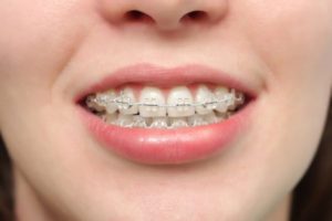 Niềng răng mất bao lâu thì có kết quả như ý? 1