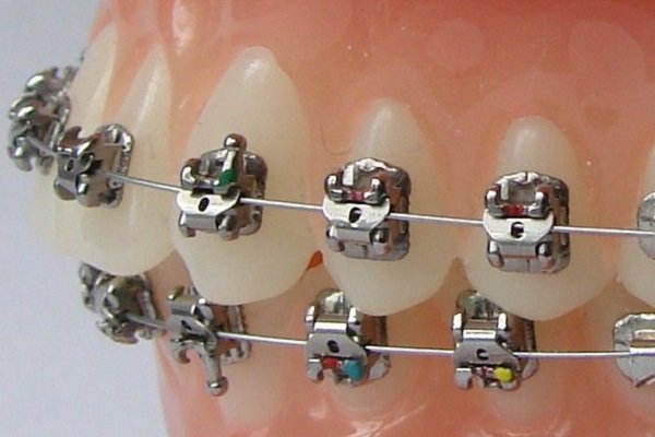 Niềng răng nhanh mất thời gian bao lâu? 3