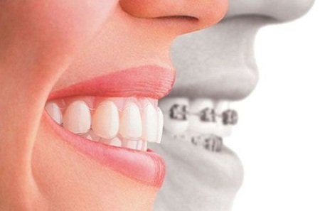 Niềng răng ở đâu tốt tại TPHCM? 3