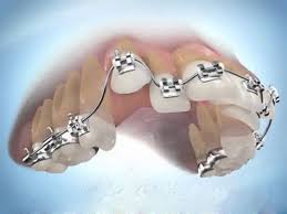 Phương pháp niềng răng lệch lạc hiện nay 3