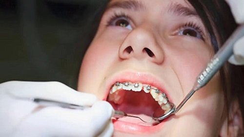 Quy trình niềng răng diễn ra như thế nào? 1