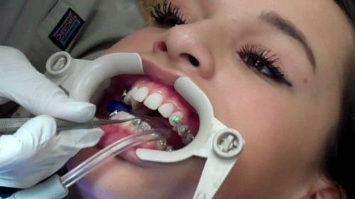 Quy trình niềng răng diễn ra như thế nào? 2