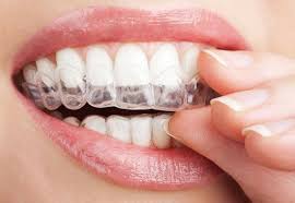 Phương pháp niềng răng tháo lắp là gì? 2