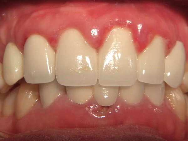 Tác hại của tẩy trắng răng