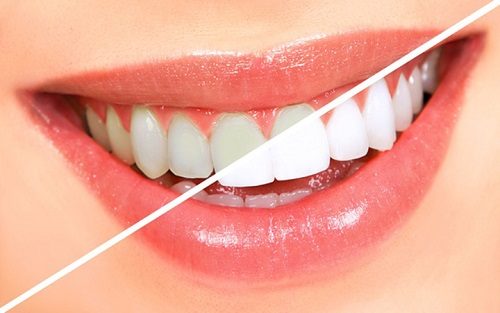Tẩy trắng răng bằng đèn plasma có hại không? 1
