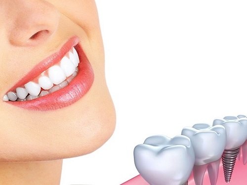 Những trường hợp cần Implant răng 1