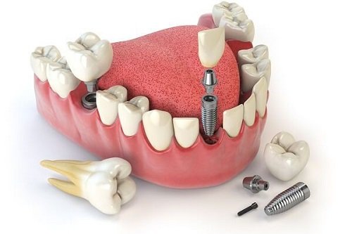 Những trường hợp cần Implant răng 2