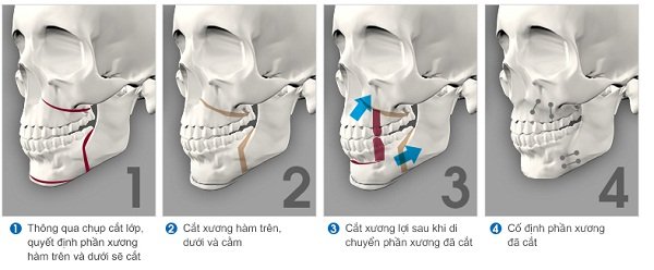 Phẫu thuật cắt xương hàm có nguy hiểm không?