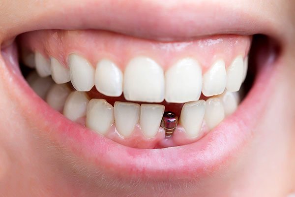 Phương pháp trồng răng giả cố định bằng Implant