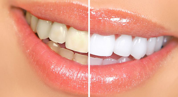 Tẩy trắng răng tại nhà bao nhiêu tiền?