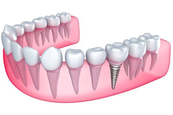 Thời gian cấy ghép răng Implant bao lâu?