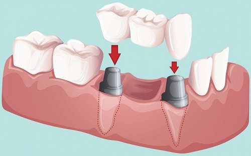 Trồng răng có đau không? 1