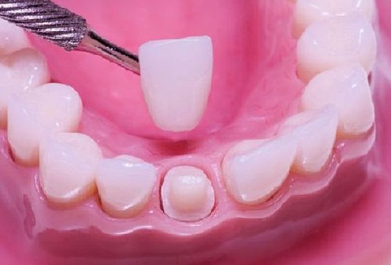 Trồng răng giả có đau không? 3