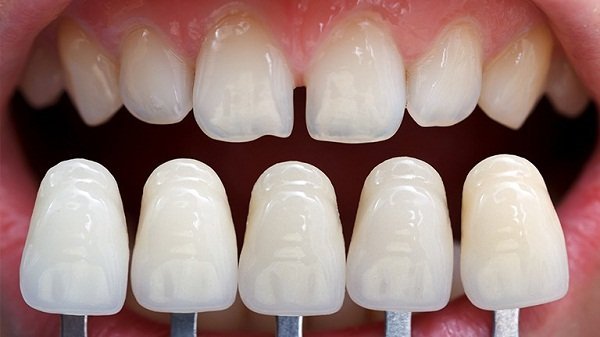Trồng răng sứ loại nào tốt nhất?