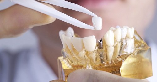 Implant răng giá bao nhiêu? 3