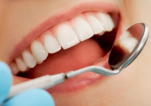 Làm răng Implant mất bao nhiêu tiền? 3