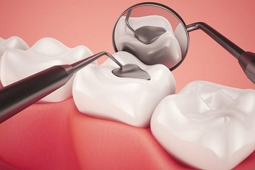 Quá trình trám răng được thực hiện như thế nào? 1