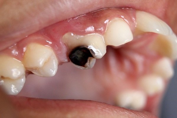 Trám răng bị sâu nặng có phải giải pháp tối ưu?