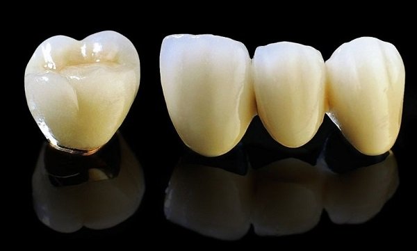 Bọc răng sứ Titan được thực hiện ra sao?