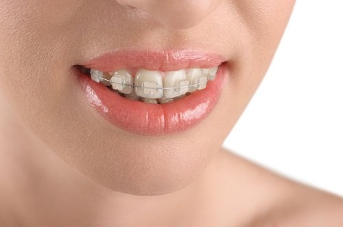 Chi phí niềng răng hô hàm trên bao nhiêu tiền? 1