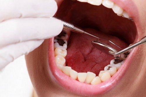 Trám răng hàm bị sâu có hiệu quả không? 1