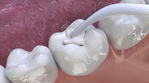 Trám răng loại nào tốt nhất? 2