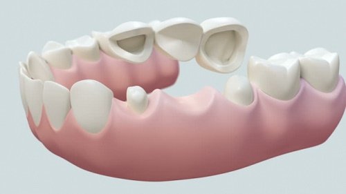 Tìm hiểu dịch vụ trồng răng bằng cầu răng 1