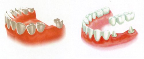 Tìm hiểu dịch vụ trồng răng bằng cầu răng 3