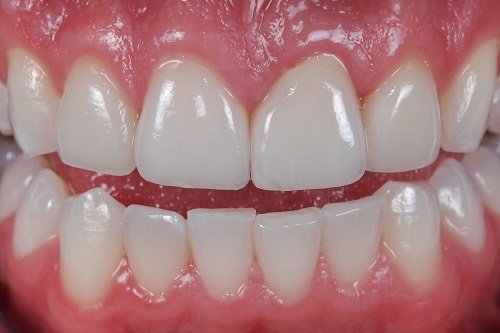 Giải pháp trồng răng có chân răng hiệu quả 1
