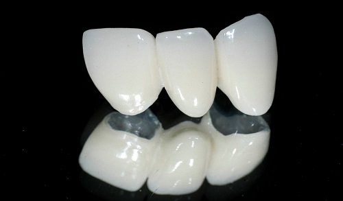 Trồng răng cửa hàm trên cần lưu ý điều gì? 2