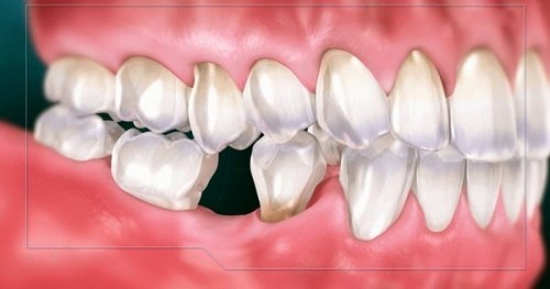 Trồng răng sứ có đau không? Tìm hiểu cách chăm sóc 1