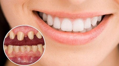 Chăm sóc sau khi bọc răng sứ cần lưu ý điều gì? 1
