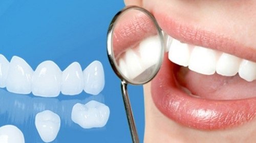 Chăm sóc sau khi bọc răng sứ cần lưu ý điều gì? 2