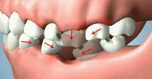 Trồng răng hàm implant giá bao nhiêu? Tham khảo giá mới nhất 1