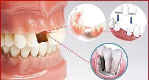 Trồng răng cửa hàm dưới với kỹ thuật nào? 1