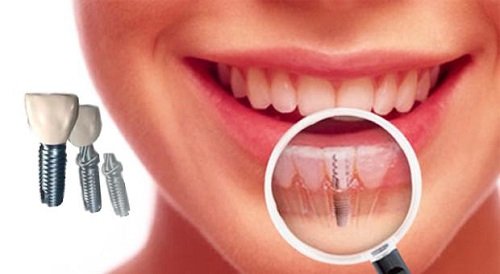 Trồng răng cửa hàm dưới với kỹ thuật nào? 2