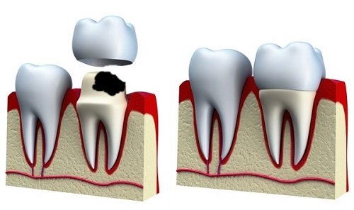 Bọc răng sứ cho răng hàm sâu - Phương pháp phục hình 1