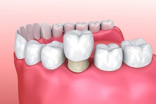 Bọc răng sứ cho răng hàm sâu - Phương pháp phục hình 2
