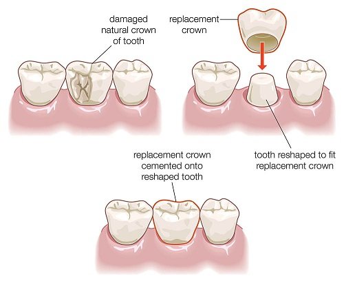 Bọc răng sứ cho răng hàm sâu - Phương pháp phục hình 3