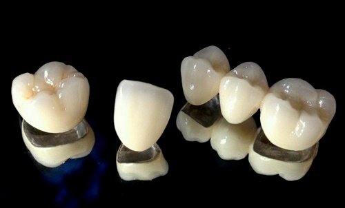 Tìm hiểu về răng sứ kim loại *