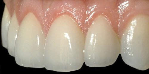 Bọc răng sứ cercon có tốt không? Chuyên gia giải đáp 1