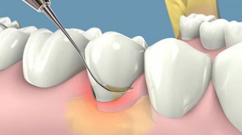 Lấy cao răng có đau không? Tìm hiểu ngay *