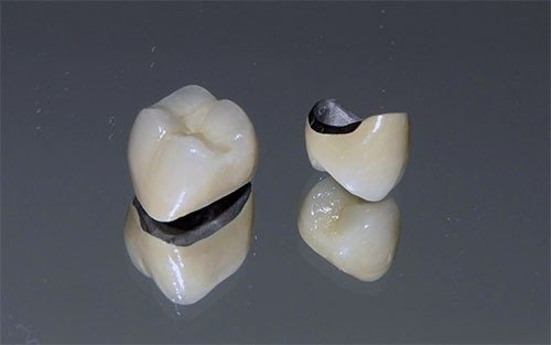 Răng sứ titan sử dụng được bao lâu? Có bền không? 2