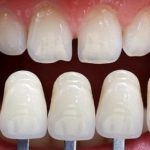 Quy trình và chi phí bọc răng sứ Zirconia