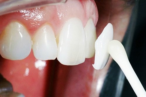 Bọc răng cửa bị thưa - Cách khắc phục tối ưu 4