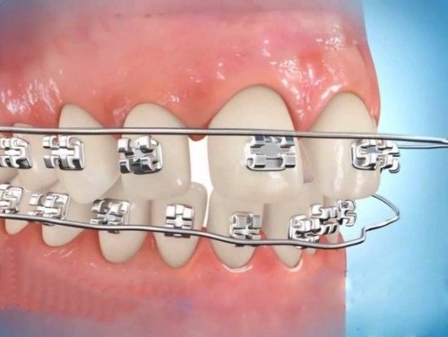 Niềng răng bị sưng lợi gây ra các biến chứng gì? 1