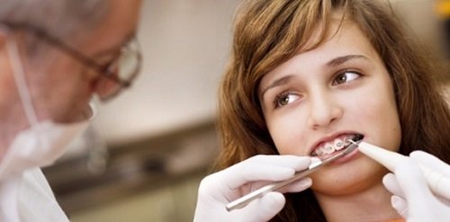 Niềng răng bị sưng lợi gây ra các biến chứng gì? 3
