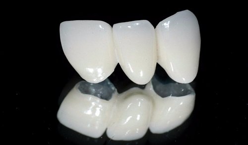 Răng sứ titan có mấy loại? Loại nào tốt? 2